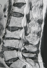 脊柱管狭窄症MRI画像