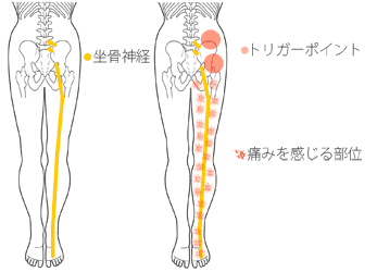 坐骨神経痛と大腰筋と梨状筋のトリガーポイント